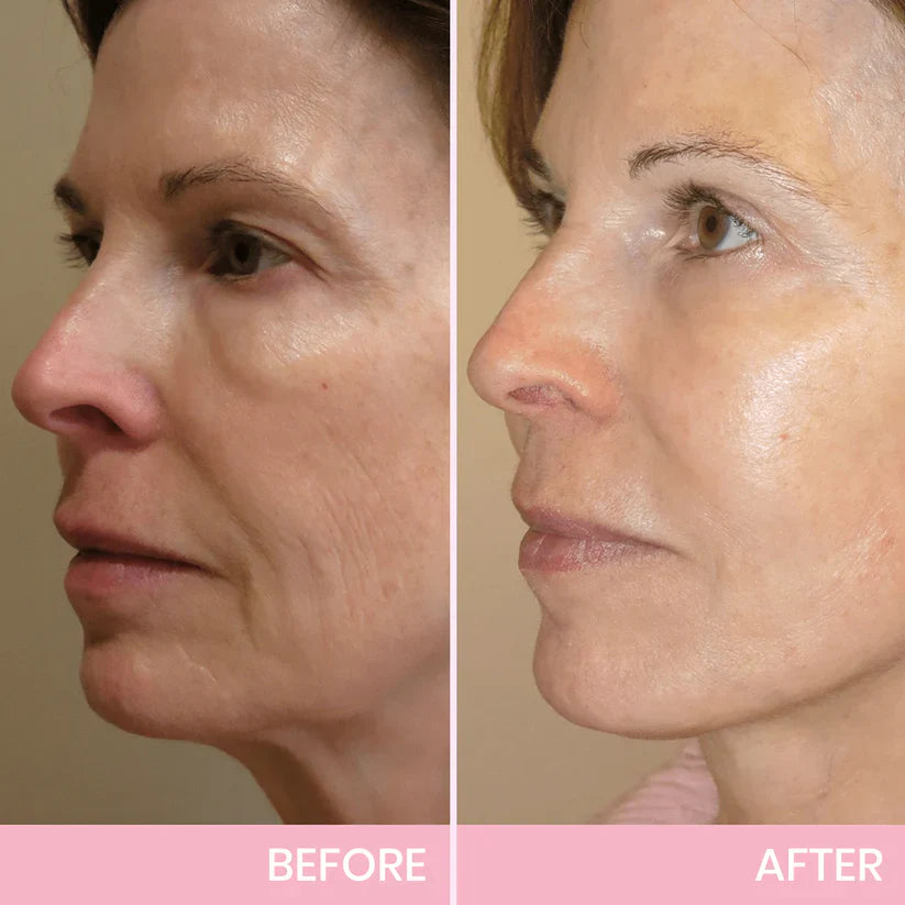 Faugettt™ V-Face Lifting Adhesive Tape